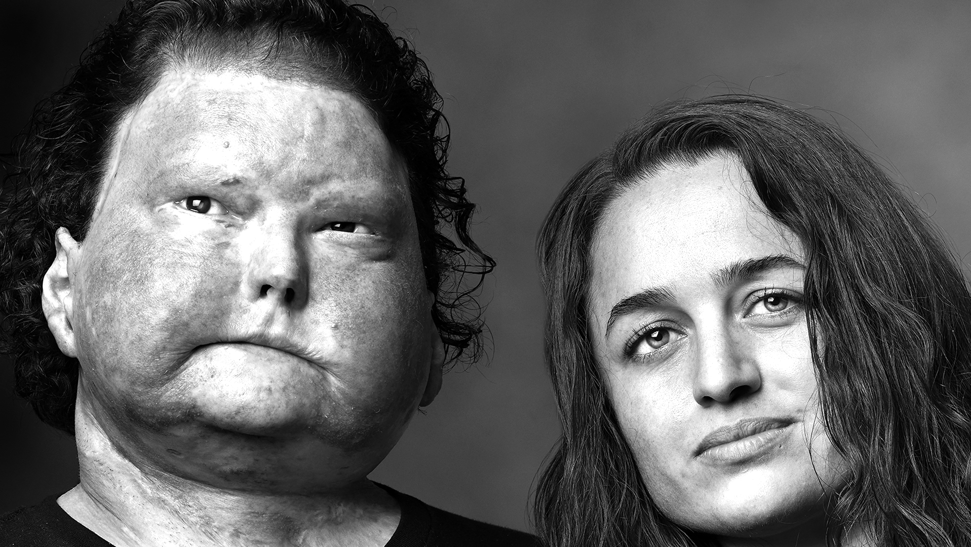 Face Transplant Patient and Wife-Joe and Jessica Dimeo (2026 Update)