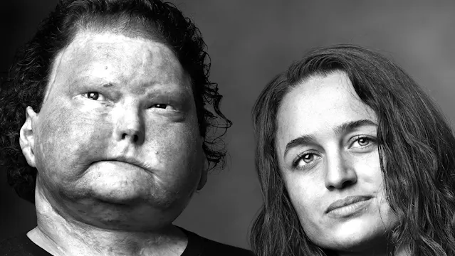 Face Transplant Patient and Wife-Joe ...