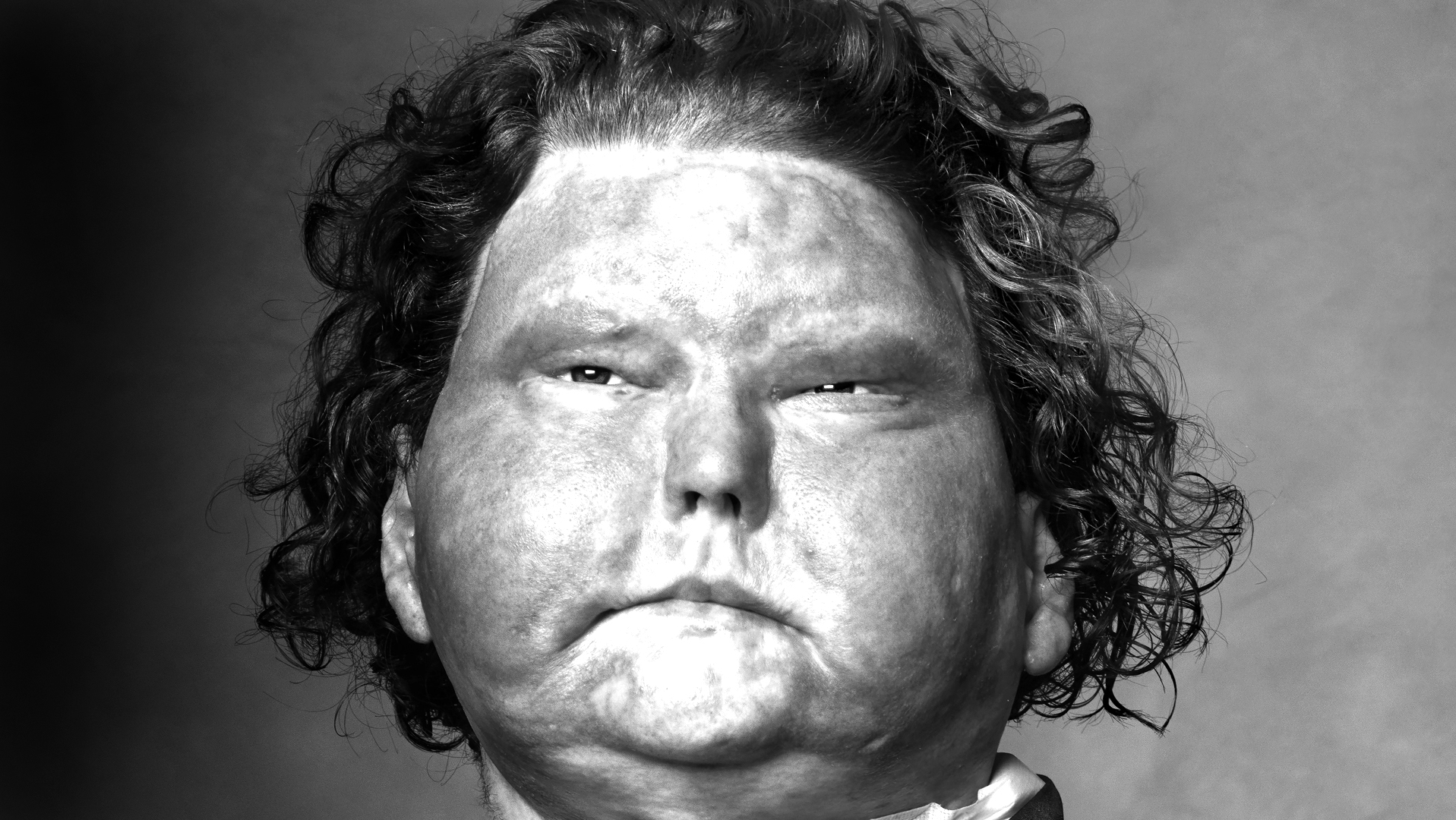 Face Transplant Recipient interview-Joe Dimeo