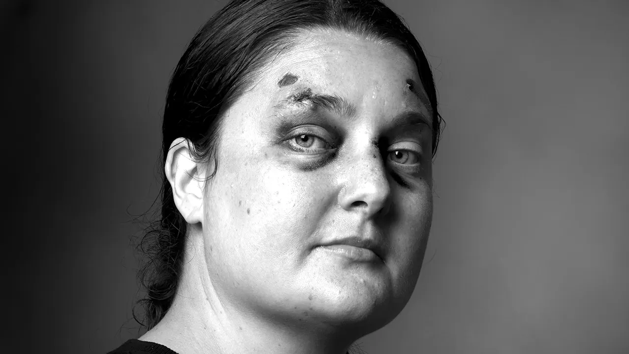 Homeless Borderline (BPD) Woman-Skye - Soft White Underbelly