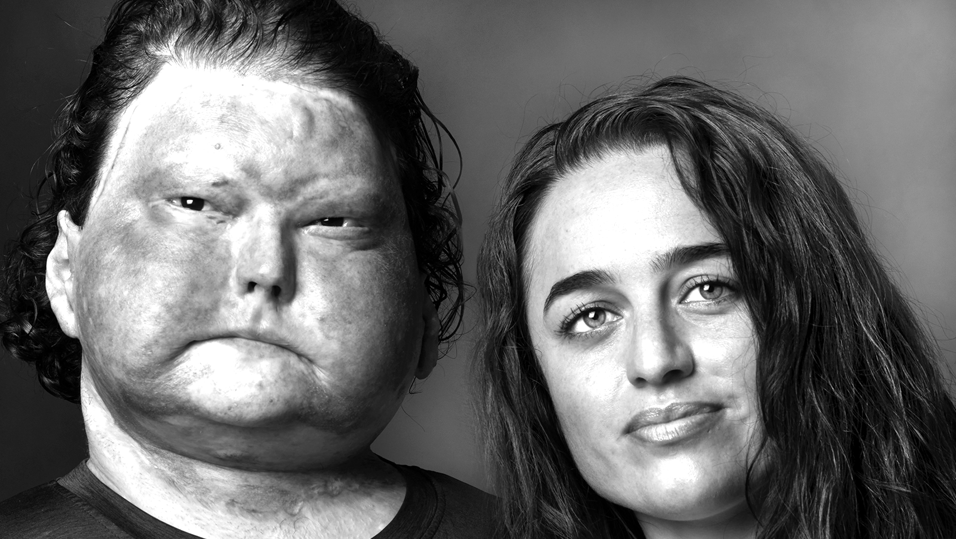 Face Transplant Patient and Wife-Joe and Jessica Dimeo