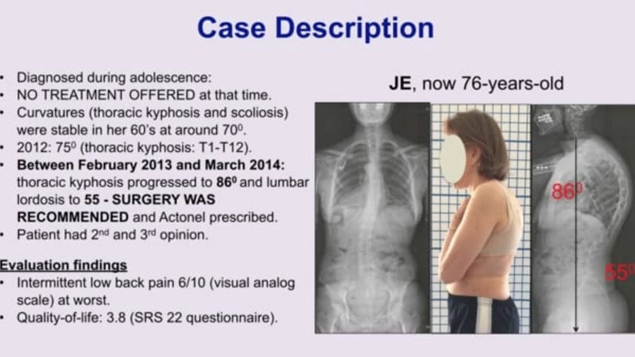 Treatment of Adult with Hyperkyphosis - Case Report by Dr. Hagit Berdishevsky