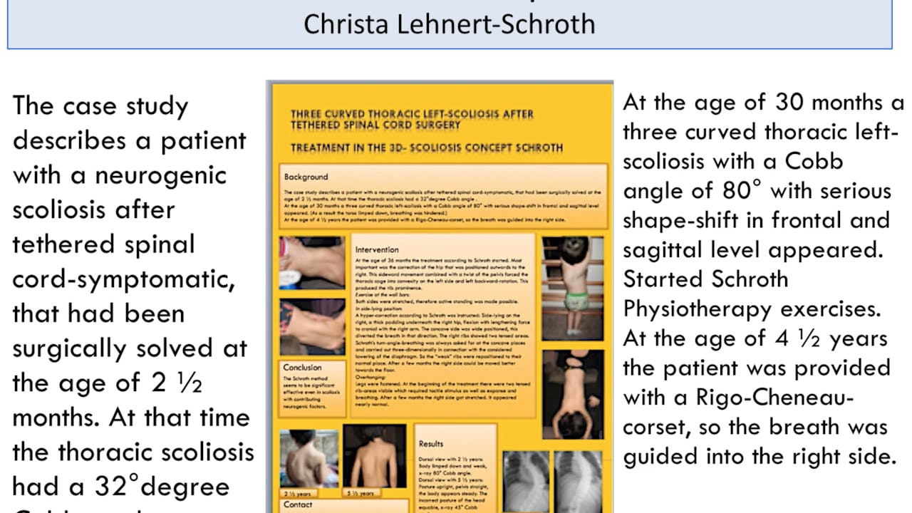 Children Diagnosed with Early Onset of Scoliosis Case Study by Andrea Lebel, M.Sc. PT