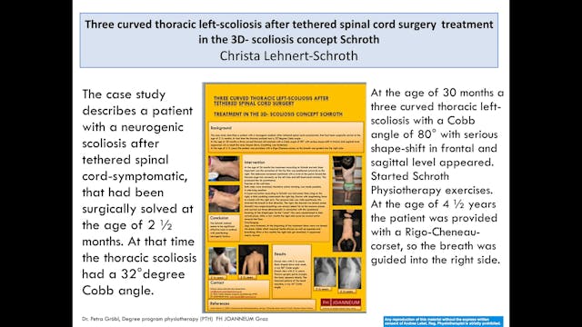 Children Diagnosed with Early Onset of Scoliosis Case Study by Andrea Lebel, PT