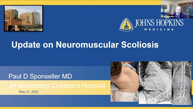 Neuro Muscular Scoliosis with P Sponseller, M.D.