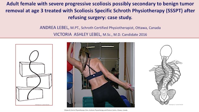 Adult Severe Scoliosis Case Study by Andrea Lebel, M.Sc. PT