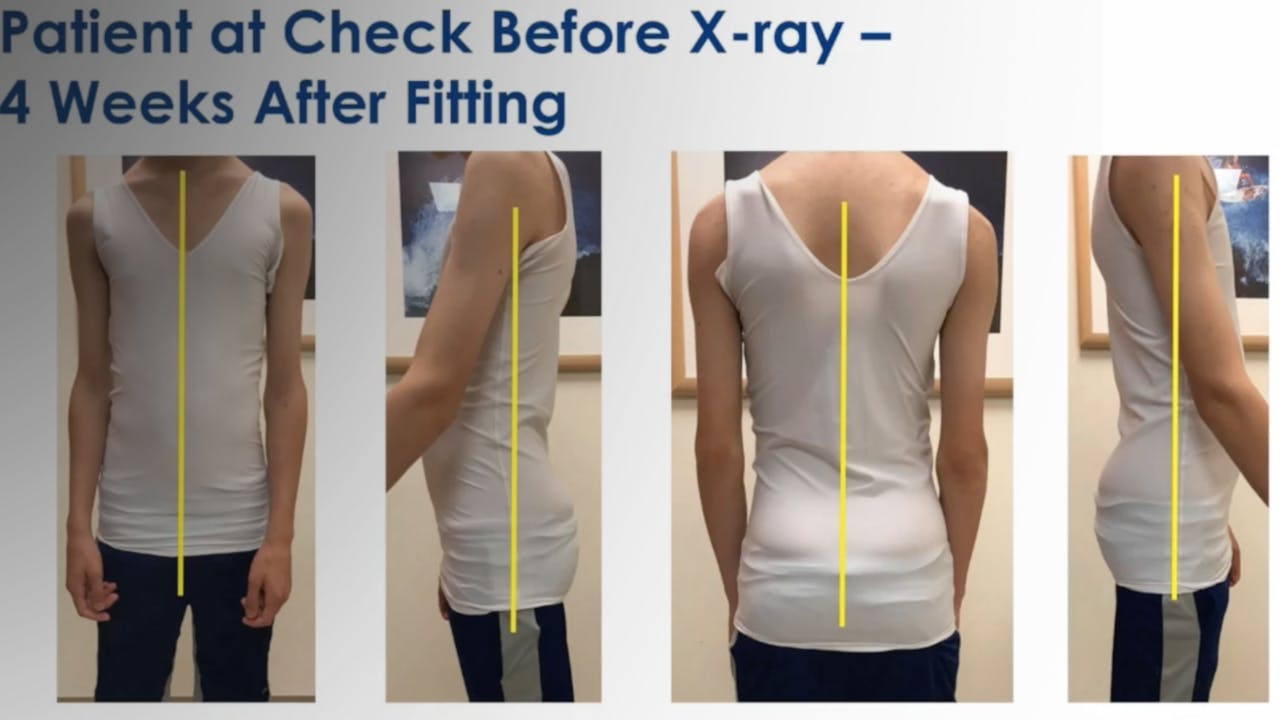 Boston Brace: First Check before X-Ray - Scoliosis and Spine Online Learning