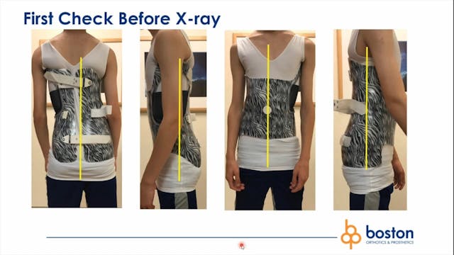 Boston Brace: First Check before X-Ray - Scoliosis and Spine Online Learning