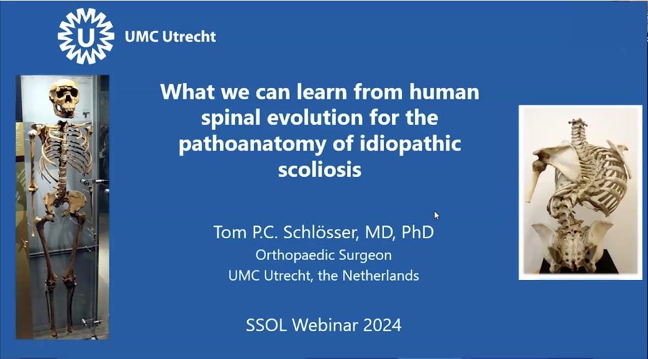 Pathoanatomy of Idiopathic Scoliosis Dr. Schlösser