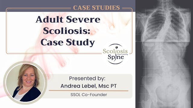 Adult Severe Scoliosis: Case Study