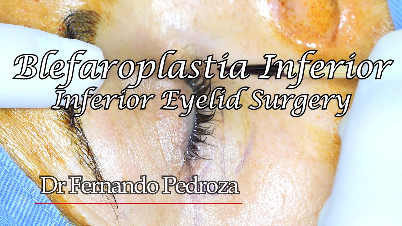 Dr Fernando Pedroza: Blefaroplastia Inferior # 1