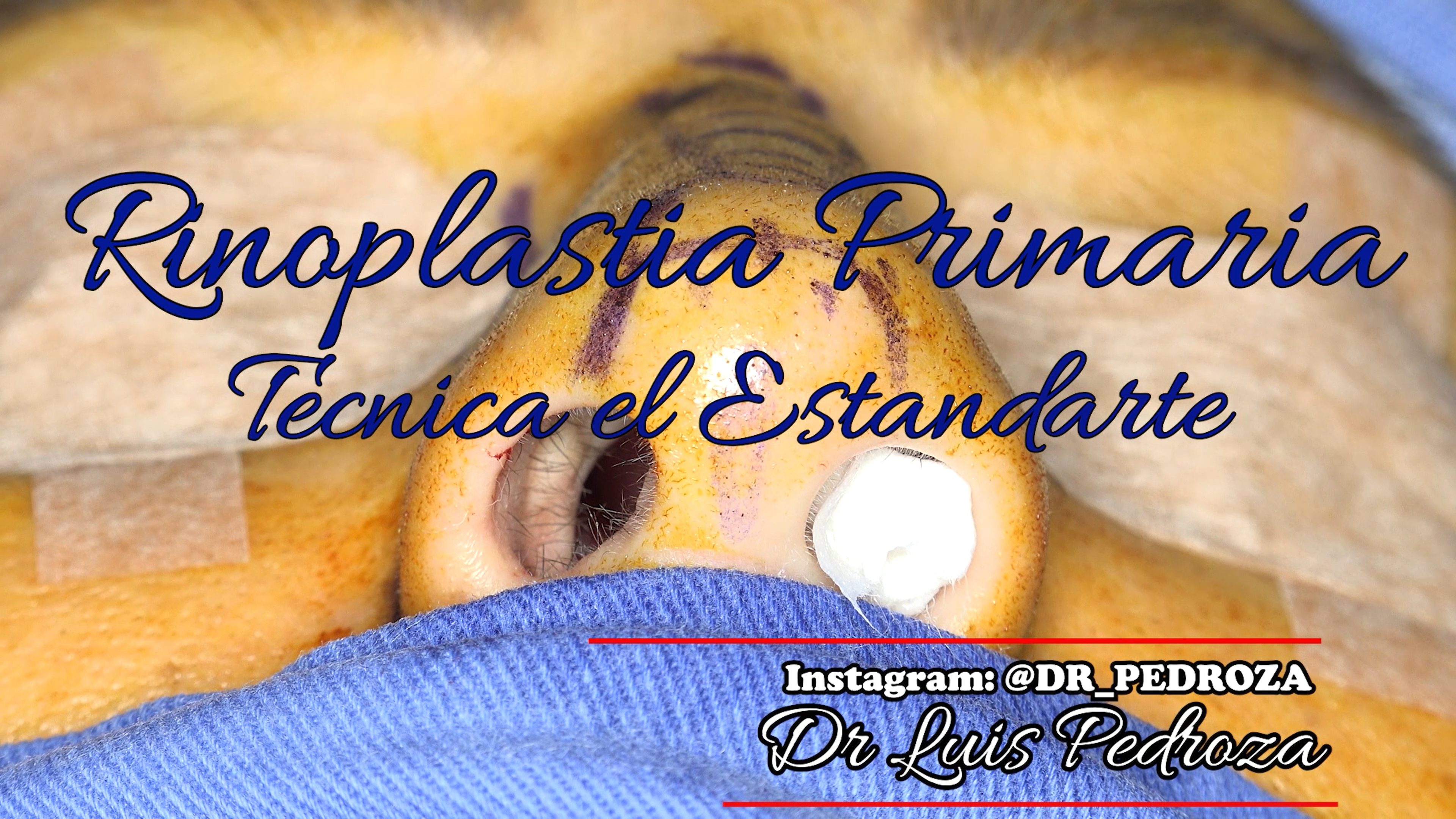 Dr Luis Pedroza: Rinoplastia Técnica el Estandarte
