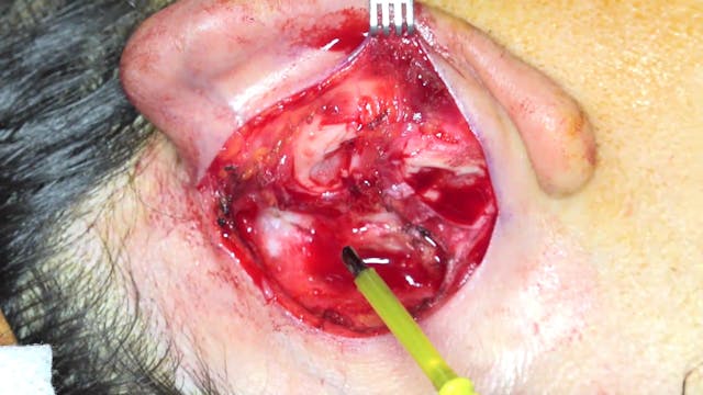 Dr Fernando Pedroza: Otoplastia #1