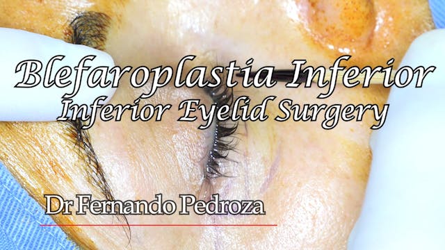 Dr Fernando Pedroza: Blefaroplastia Inferior # 2