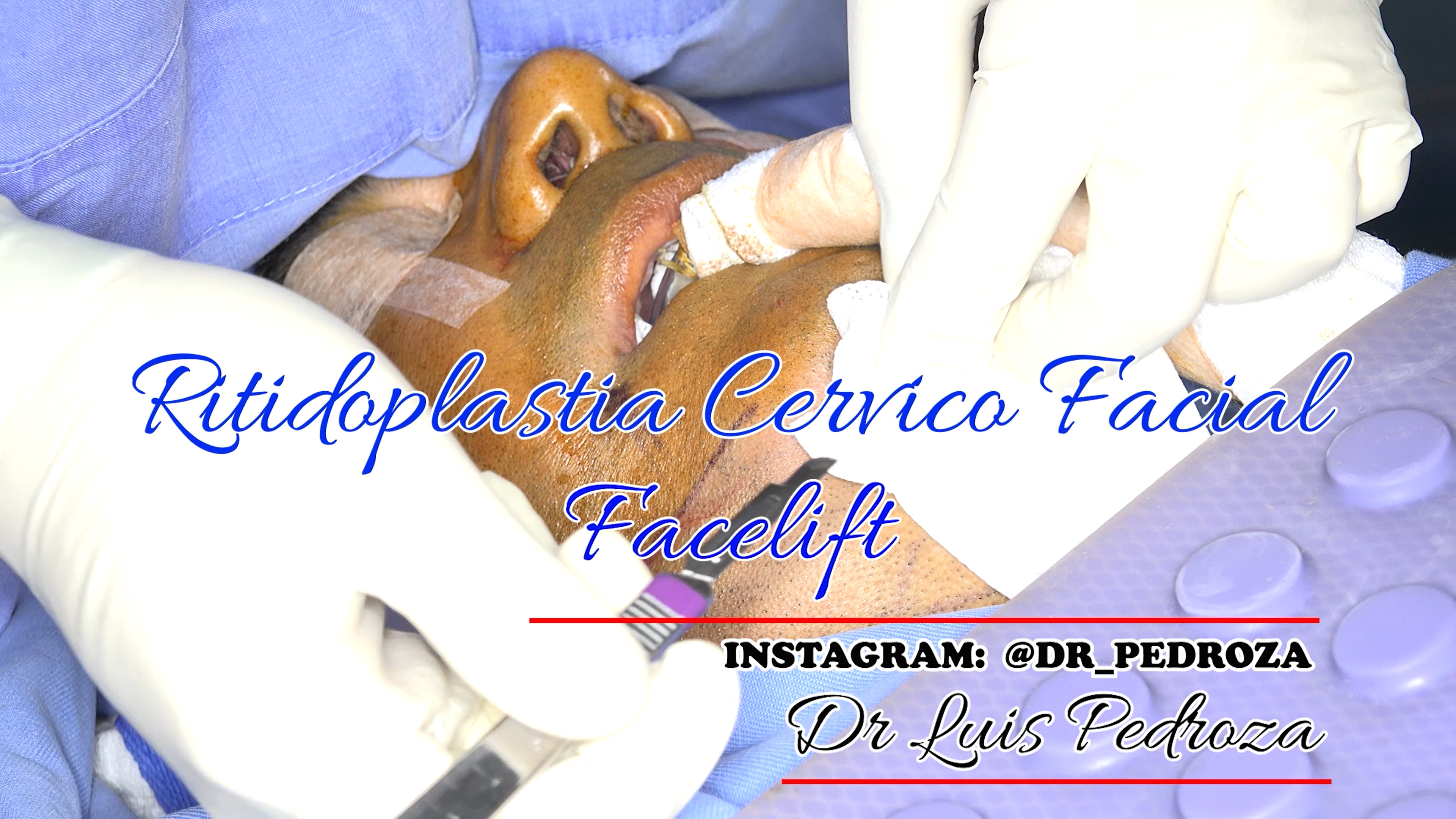 Dr Luis Pedroza: Ritidoplastia # 1