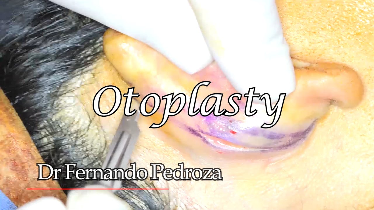 Dr Fernando Pedroza: Otoplastia # 1