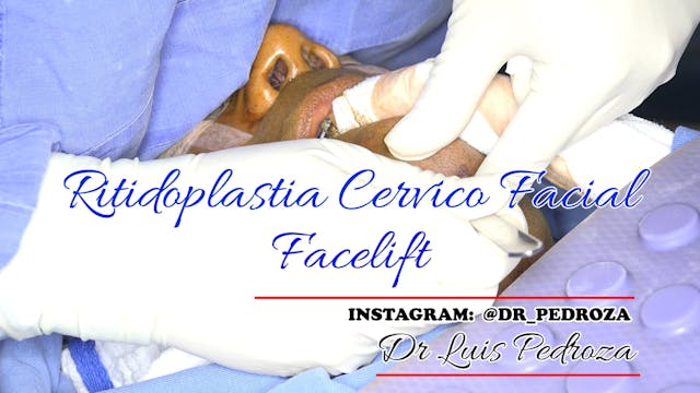 Dr Luis Pedroza: Ritidoplastia # 1