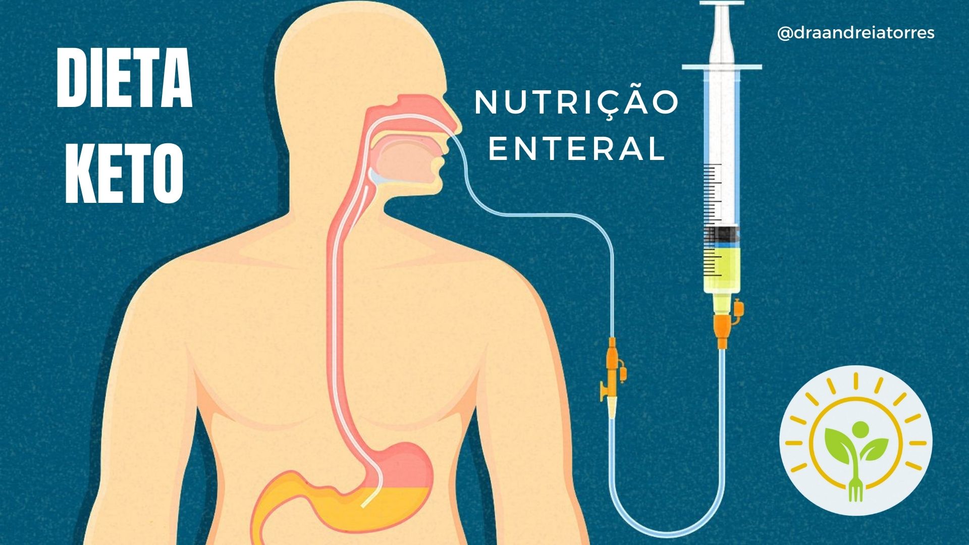 Terapia nutricional enteral cetogênica