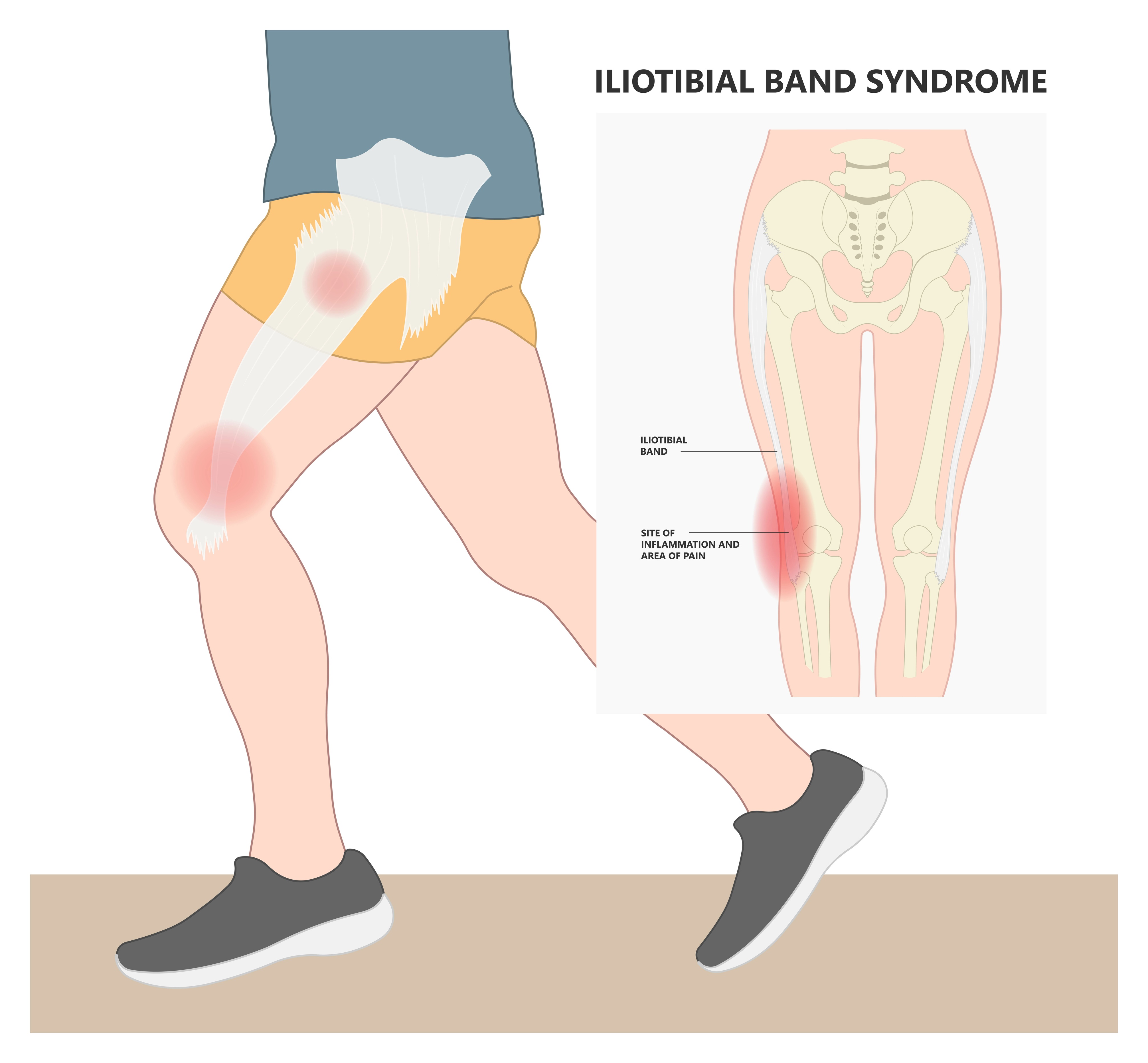 Telehealth Physical Therapy for Runner's Knee