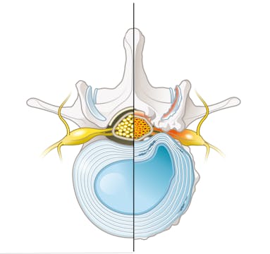 Telehealth PT for Cervical Radiculopathy