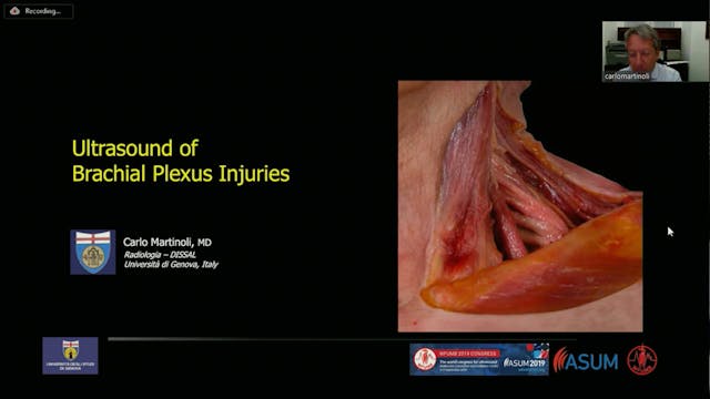 Ultrasound of brachial plexus injuries
