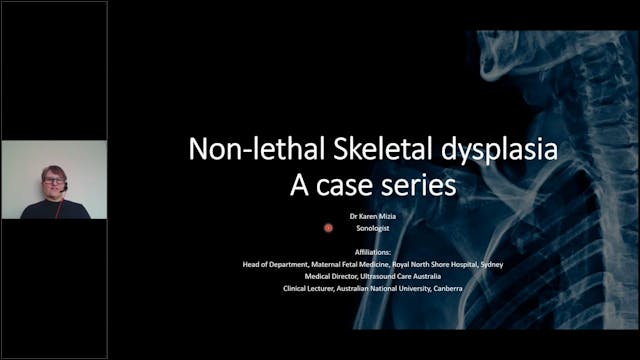 Non-lethal Skeletal Dysplasia - A Cas...