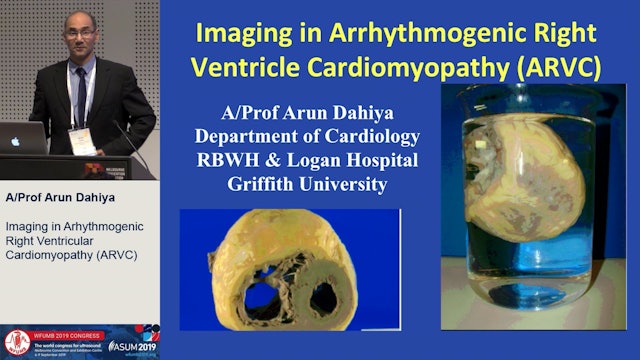 Imaging in Arhythmogenic Right Ventricular Cardiomyopathy