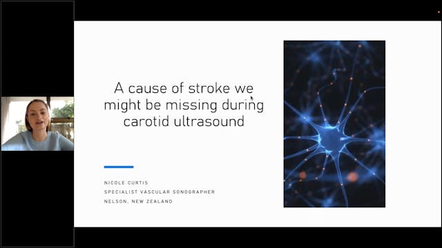 Another cause of stroke we might be m...