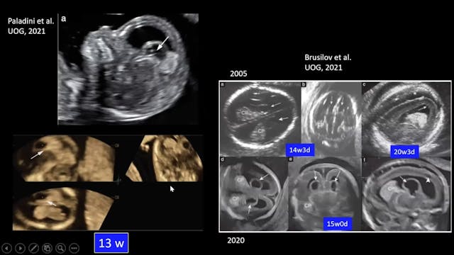 Targeted Neurosonography