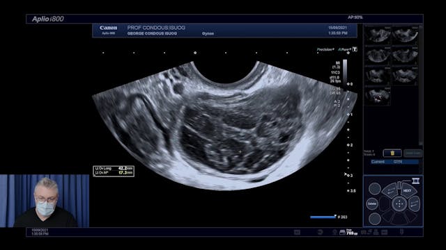 Live scan: Endometriosis (ISUOG) - Ca...