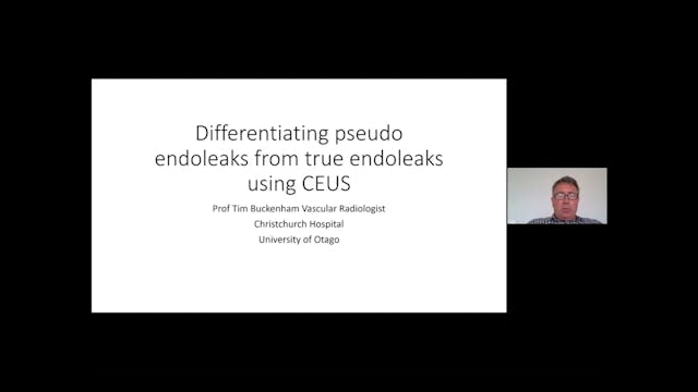 Differentiating pseudo endoleaks from...