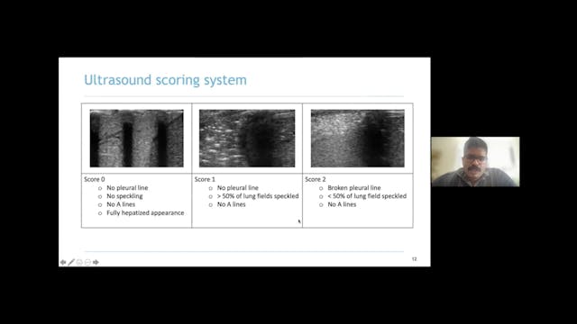 Lung US of the Dependent Lung Detects...