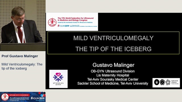 Mild ventriculomegaly: The tip of the iceberg