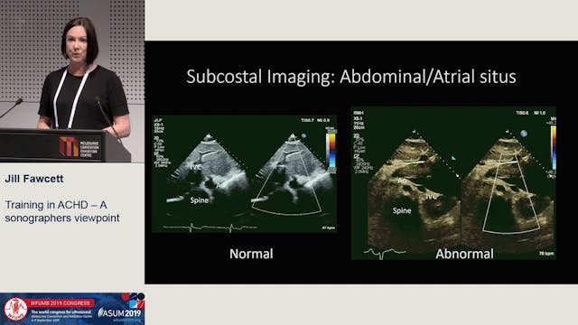 Training in ACHD - a sonographer's vi...