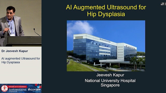 AI augmented 3D ultrasound for hip dysplasia