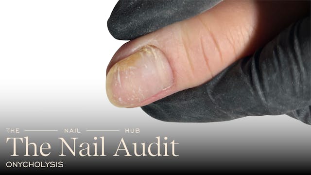 Understanding Onycholysis: What It Is...