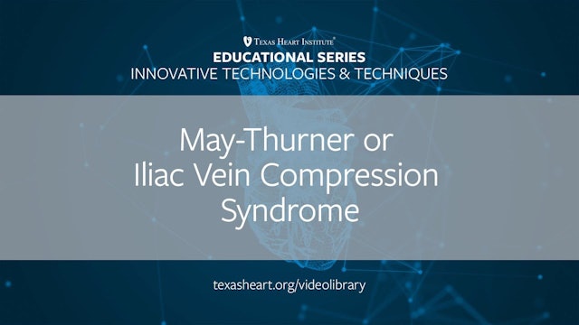 May-Thurner or Iliac Vein Compression Syndrome (0.50)