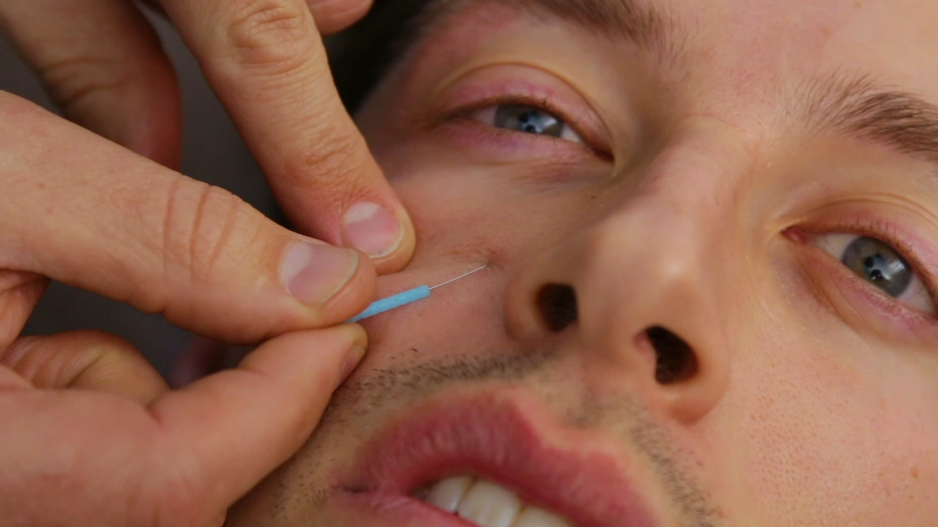 The Try Guys Try Acupuncture