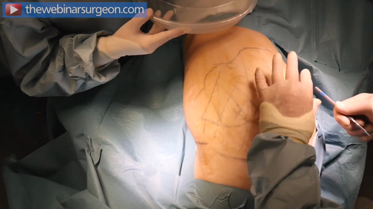 Fat Harvesting Abdomen to Aquavage, James Frame 3