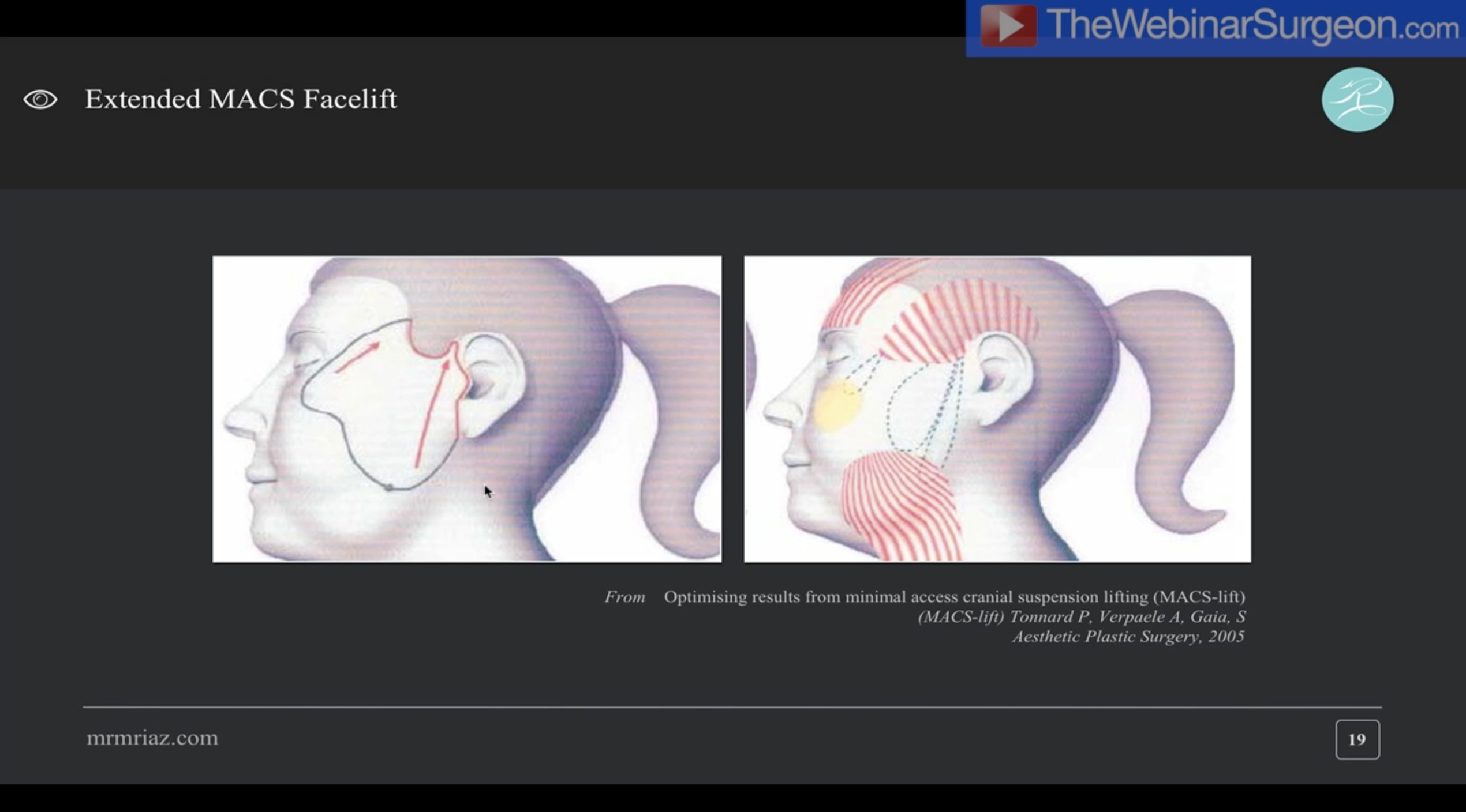 'R' Facelift Technique - Webinar, Muhammad Riaz