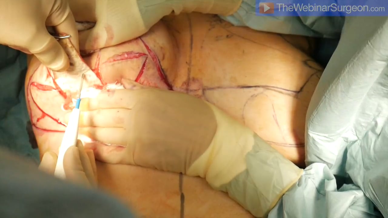 Dermal Wings Technique, Muhammad Riaz