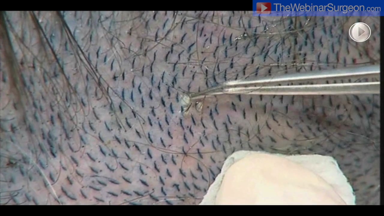 Hair Transplant Techniques 2, Greg Williams