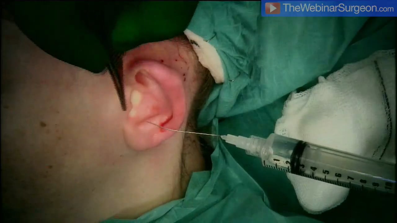 Posterior Approach Pinnaplasty 2, Tariq Ahmad