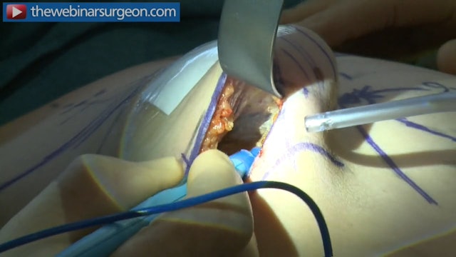 Breast Augmentation, Conical Implant, J Frame