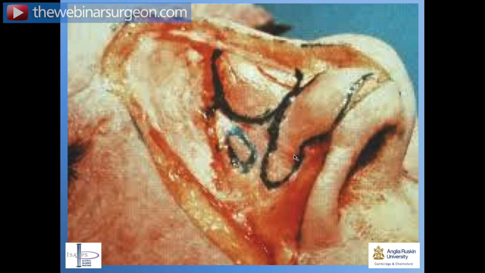 Closed Approach to Rhinoplasty, J Frame