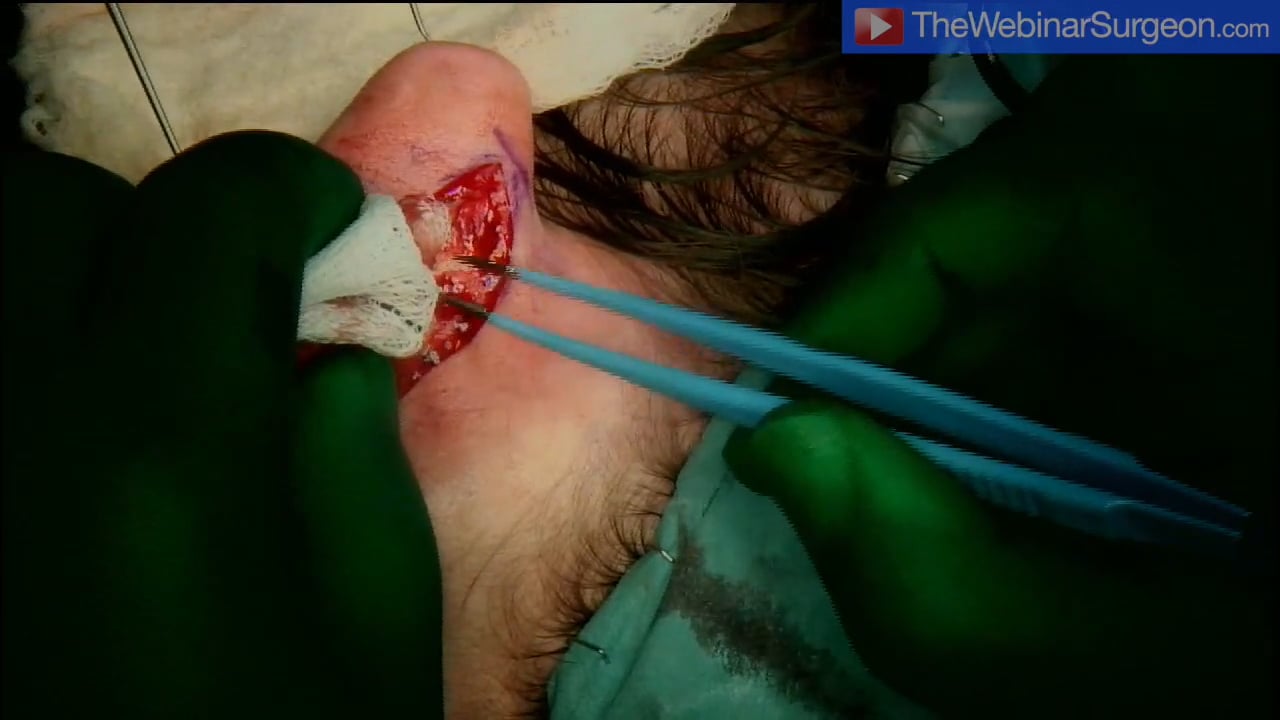 Posterior Approach Pinnaplasty 1, Tariq Ahmad