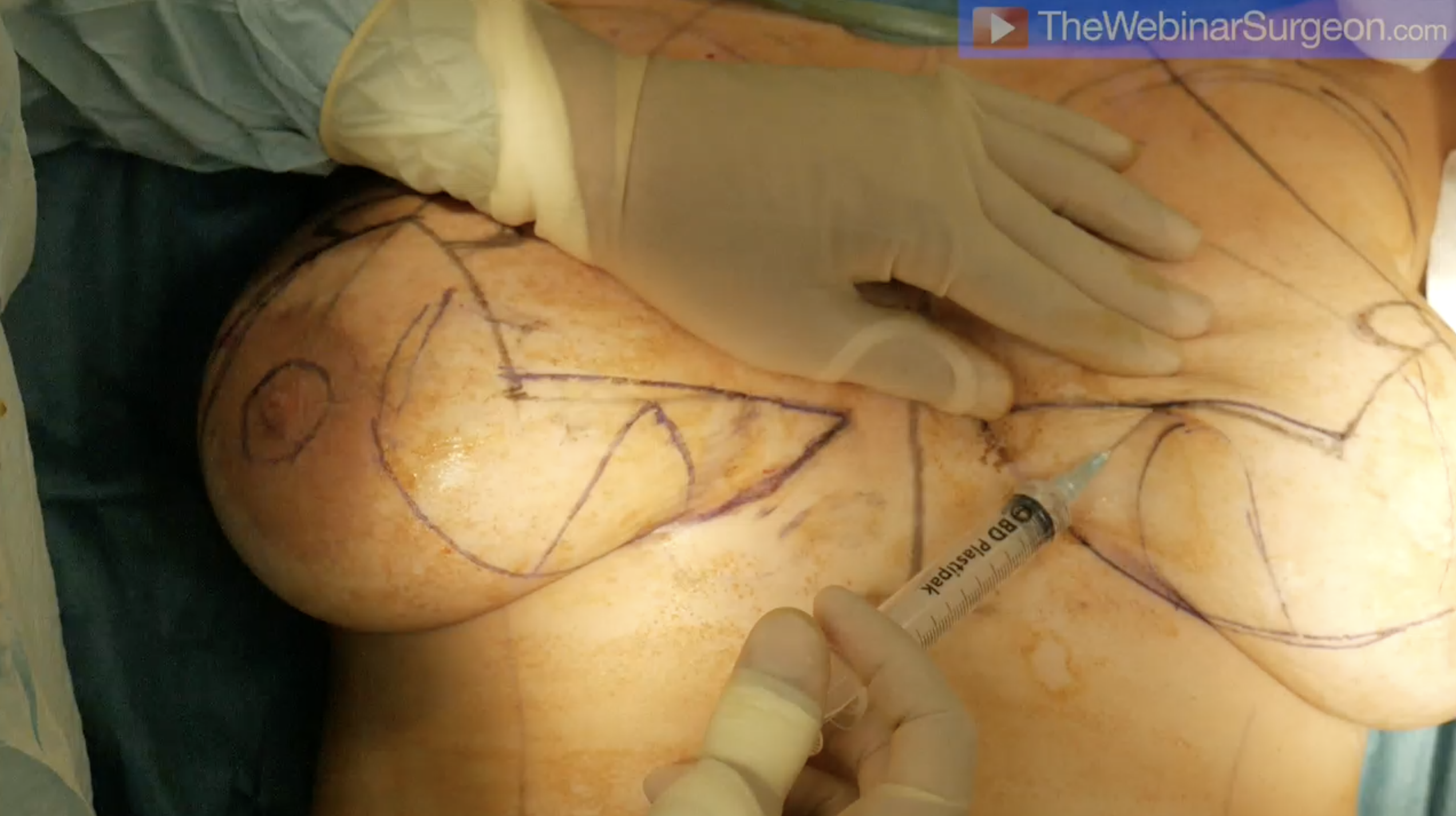 'Dermal Wings' Breast Reduction, Mr Muhammad Riaz