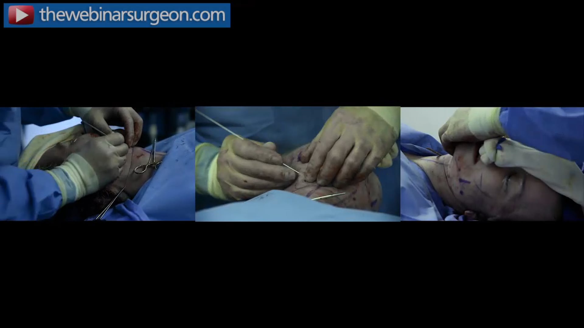 Placement of Trampoline Platysmaplasty, Greg Mueller