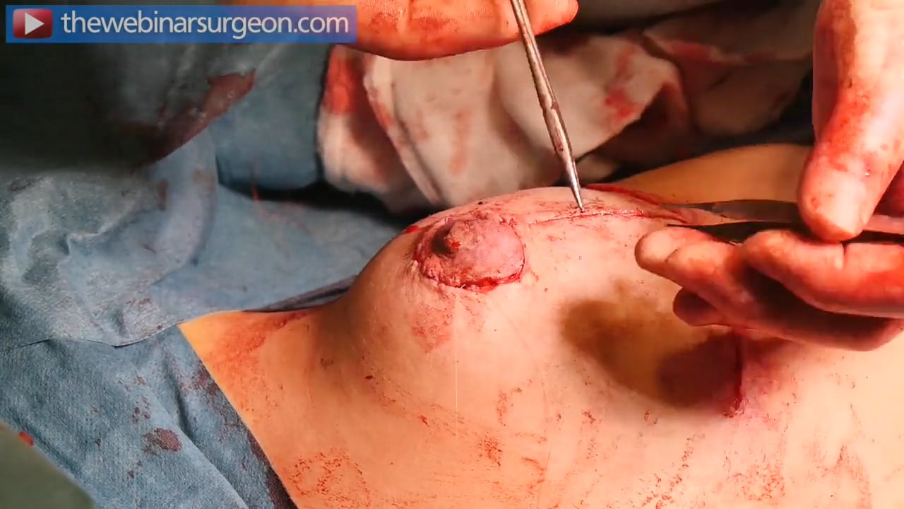 Superior Pedicle Mastopexy, left, J Frame 2b