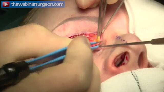 Upper Blepharoplasty, James Frame